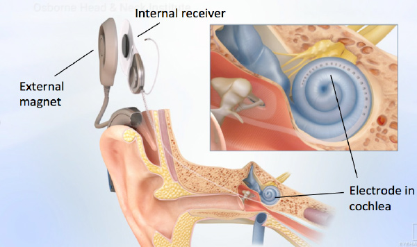Figure: Illustration of the ear demonstrating a cochlear implant’s external and internal components.