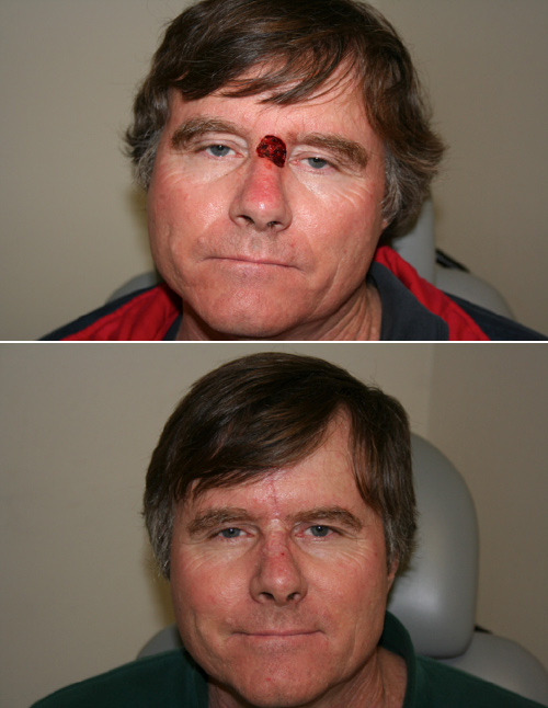 Dorsal Nasal Flaps: This rotational flap takes tissue from the glabella, an area between the eyebrows, to reconstruct the nasal dorsum and sidewalls of the nose. These donor areas create large enough skin grafts to even cover the tip of the nose.