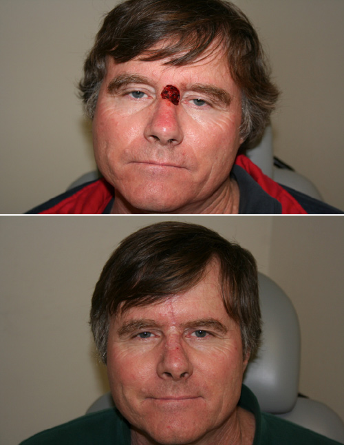 Nasal Skin Cancer Reconstruction