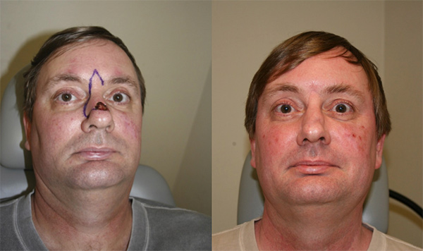 Before (left) and after (right) nasal reconstruction.
