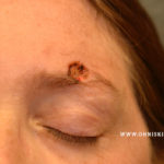 Skin Cancers Involving the Eyebrow: Clinical Considerations