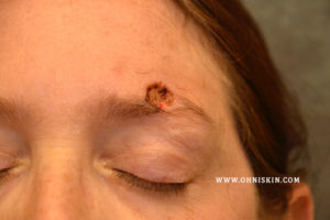 Read more about the article Skin Cancers Involving the Eyebrow: Clinical Considerations