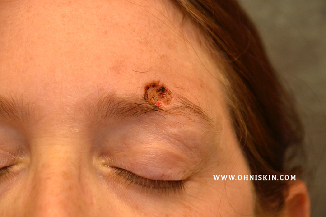 Figure 1: Large defect after skin cancer removal. Defect involves a major portion of the eyebrow.