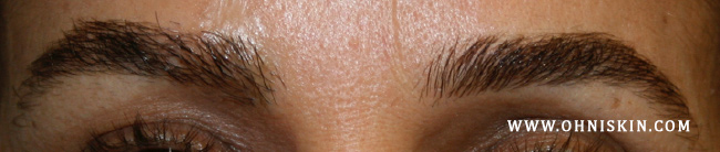 Figure 3b: One year after hair transplant to the right eyebrow.
