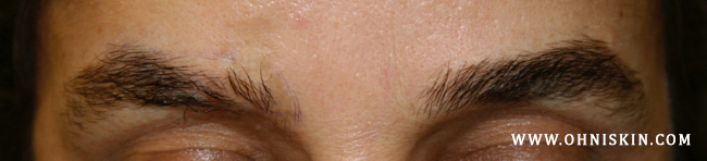 Figure 3a: Scar leading to hair loss of the right eyebrow.