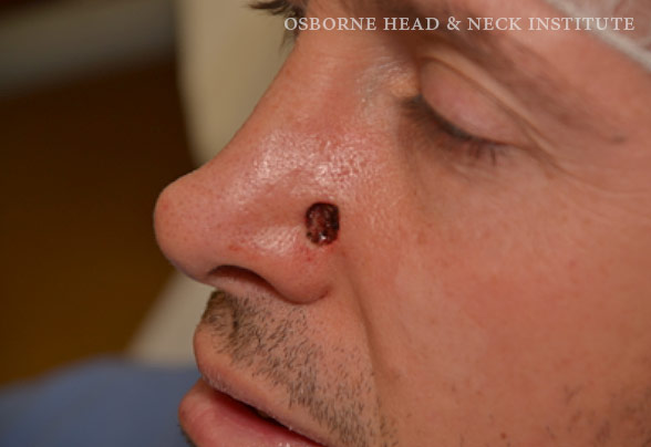 skin-cancer-nose-surgery-ohni