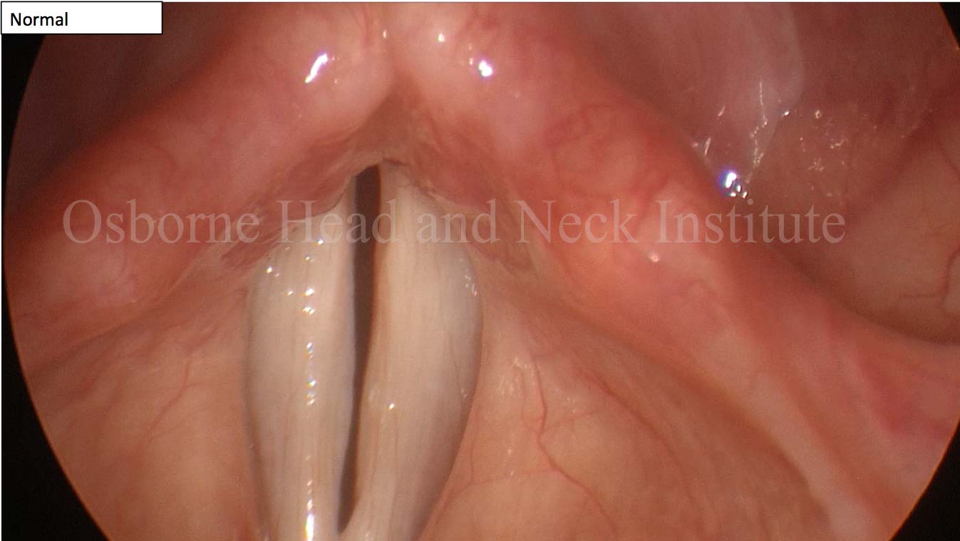 Vocal Curbside Consult Vocal Recovery After Illness Los Angeles ENT