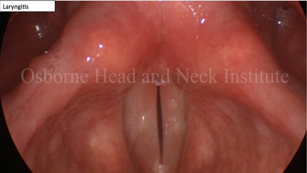 Vocal Curbside Consult Vocal Recovery After Illness Los Angeles ENT