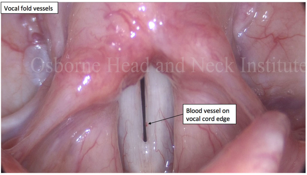 estrogen affect voice