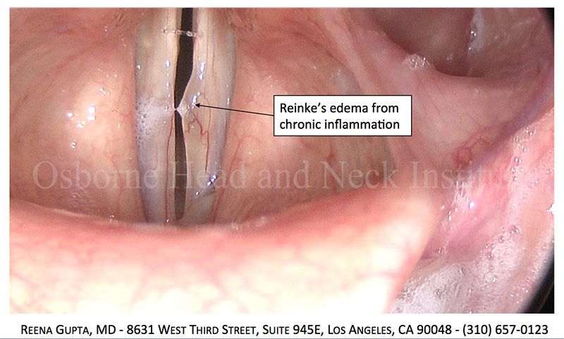 reinkes edema