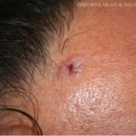 Skin Cancer: An Overview