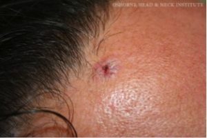 Read more about the article Skin Cancer: An Overview