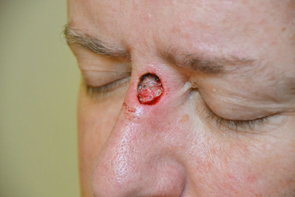 basal cell carcinoma nose scar