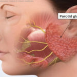 The Effect of Bulimia on the Parotid Gland