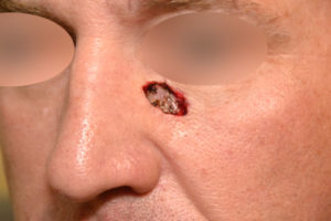 Read more about the article Clinical Considerations of Mohs Reconstruction of Cheek Defect
