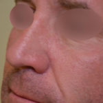 Basal Cell Carcinoma: Facial Reconstruction Timing