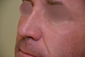 Read more about the article Basal Cell Carcinoma: Facial Reconstruction Timing
