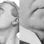 Chin Implants on the Rise