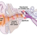 Adult Cochlear Implants: An Overview