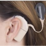 Adult Cochlear Implants: Surgery and What to Expect