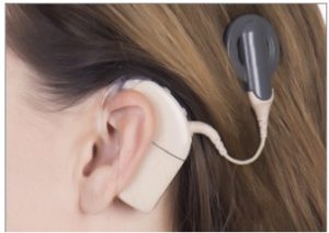 Read more about the article Adult Cochlear Implants: Surgery and What to Expect