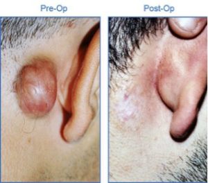 Read more about the article Keloid Treatment Options