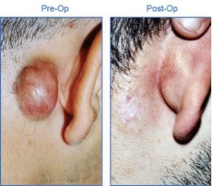 Read more about the article Keloid Treatment Options