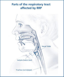 Read more about the article Treatment of Recurrent Respiratory Papillomatosis