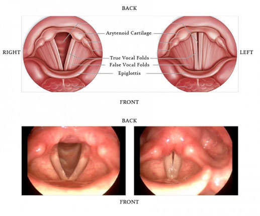 ENT condyloma