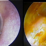 The Dangers of Untreated Exostosis / Surfer’s Ear