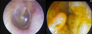 Read more about the article The Dangers of Untreated Exostosis / Surfer’s Ear