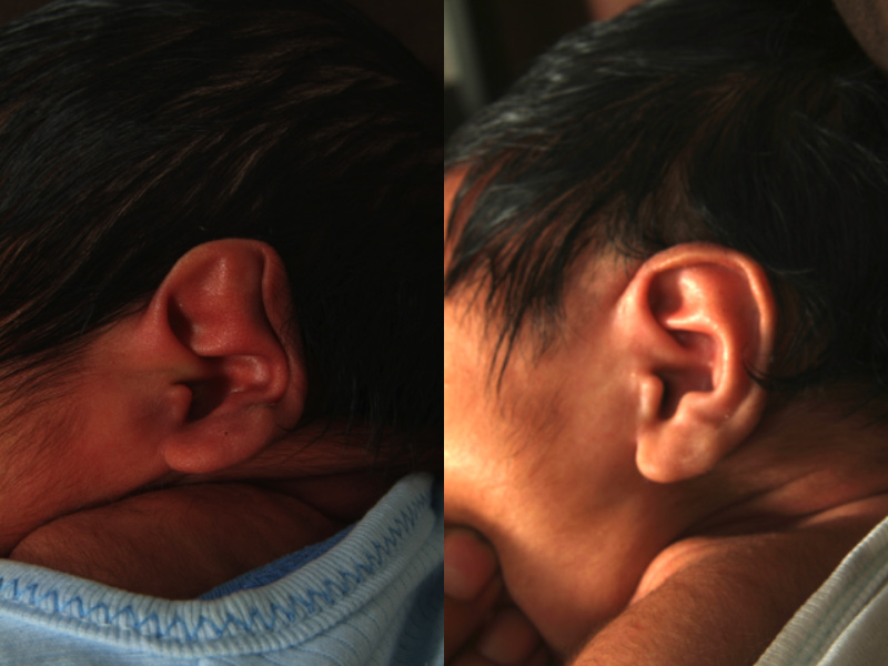 ear molding