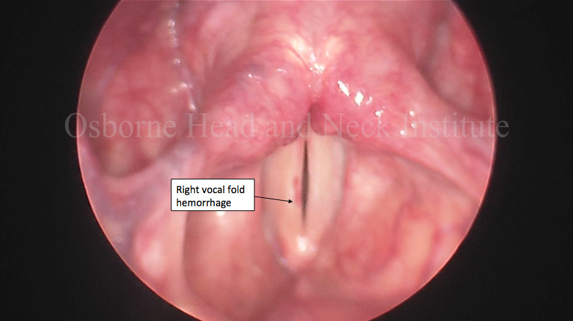 vocal fold hemorrhage