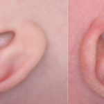 Newborn Ear Deformity: What Can Be Done?