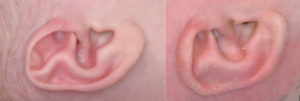Read more about the article Newborn Ear Deformity: What Can Be Done?