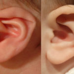 Folded Ear in Newborns: Treatment Options