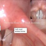 Vocal Injury from Intubation