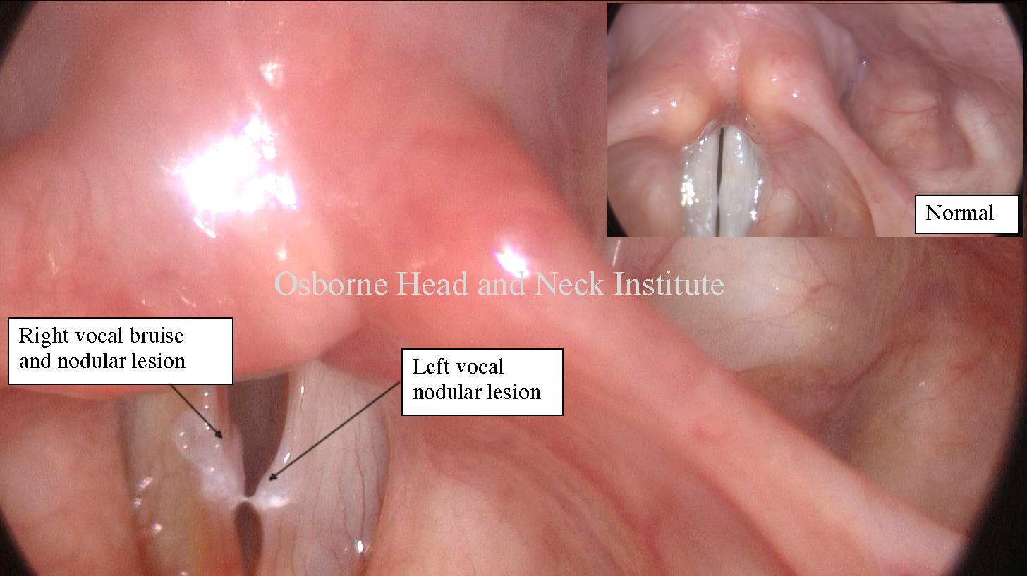 vocal injury intubation