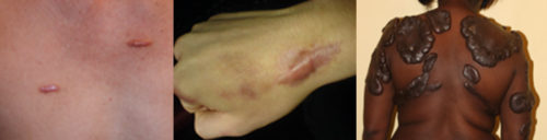 Scar Revision for Surgical, Traumatic, and Keloids Scars