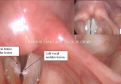 vocal injury intubation